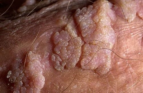Infectia cu virusul papiloma uman (HPV) | sanchi.ro
