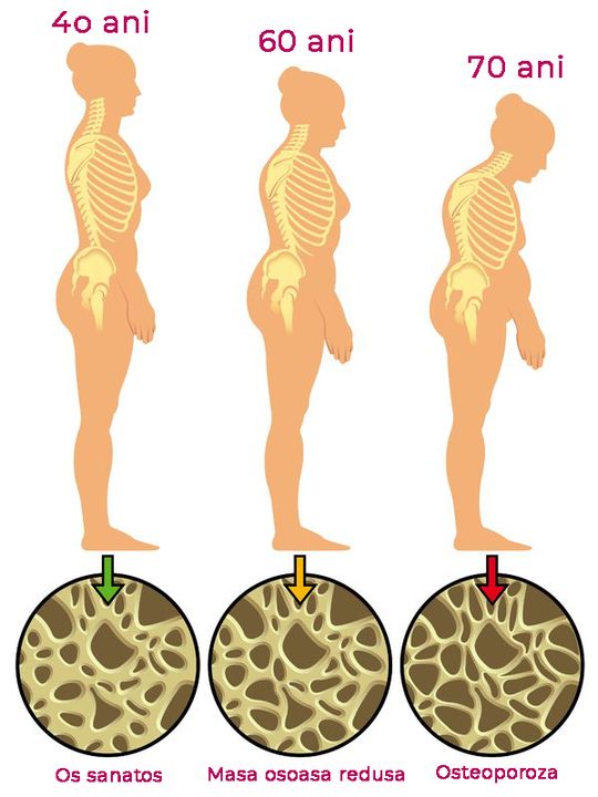 stagiile osteoporozei