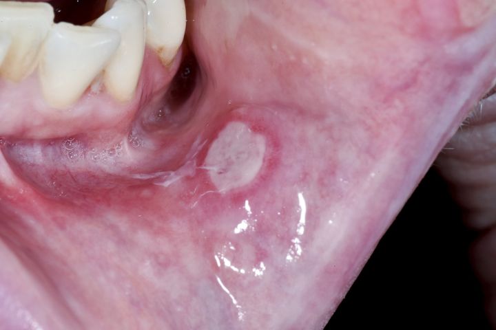 ulcer oral
