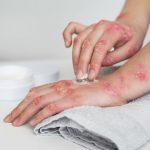 Boala Lyme - Când aceasta devine o urgență medicală? 28 boala lyme tratament