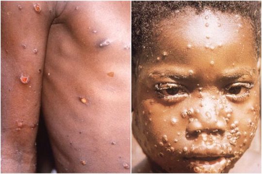 Variola Maimuței. Cum se transmite și cât este de mortală? 10 variola maimutei poze