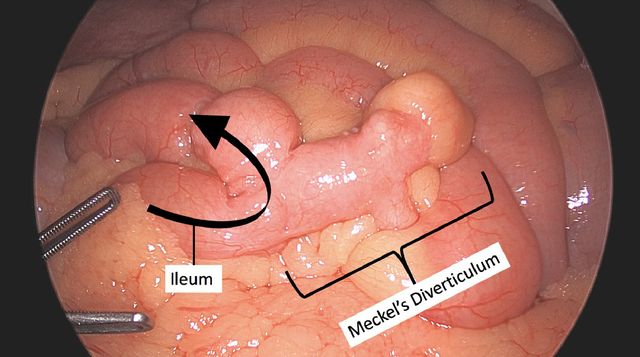 Ce este și cum se tratează diverticulul Meckel? 6 diverticulul meckel poze