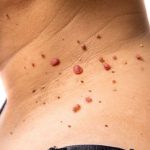 ca tratament naturist papiloame