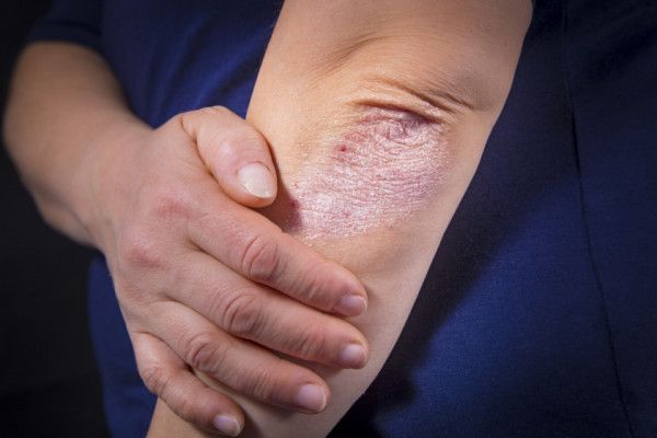 Psoriazis. Cum arată, cât de grav este și cum se tratează? 8 Psoriazis. Cum arată, cât de grav este și cum se tratează? 2