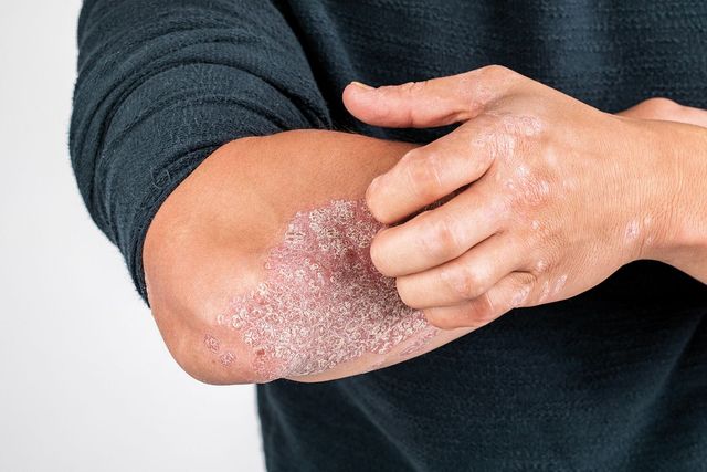 Psoriazis. Cum arată, cât de grav este și cum se tratează? 10 Psoriazis. Cum arată, cât de grav este și cum se tratează? 4