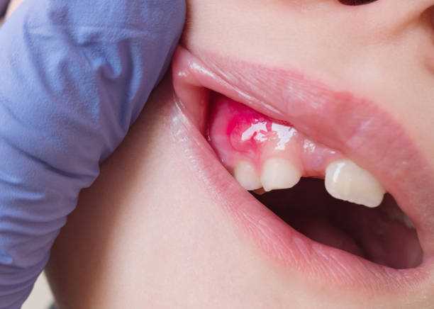 Abcesul dentar. Când mergem la stomatolog de urgență? 1