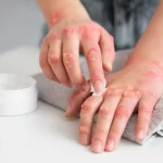 Ce este și cum scapi de dermatita seboreică