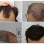 Implant de păr prin tehnica Q-FUE în cadrul clinicii Dr. Felix Hair Implant 29 Implant de păr prin tehnica Q-FUE în cadrul clinicii Dr. Felix Hair Implant