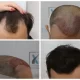Implant de păr prin tehnica Q-FUE în cadrul clinicii Dr. Felix Hair Implant